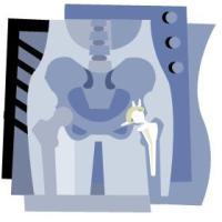 Joint Replacement Metal Toxicity